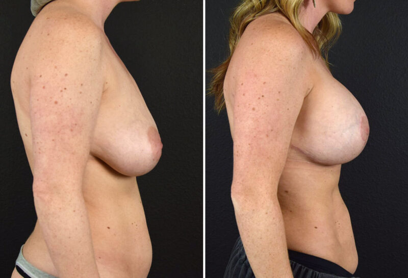 Breast Augmentation with Lift Before and After results