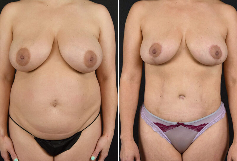 Mommy makeover with breast reduction before and after results