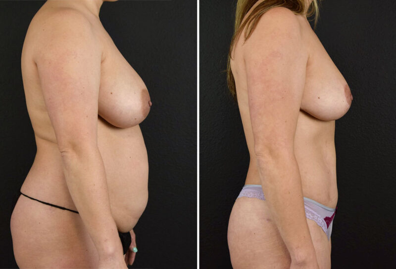 Mommy makeover with breast reduction before and after results