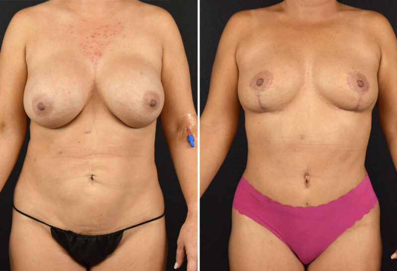 Mommy makeover with breast reduction before and after results