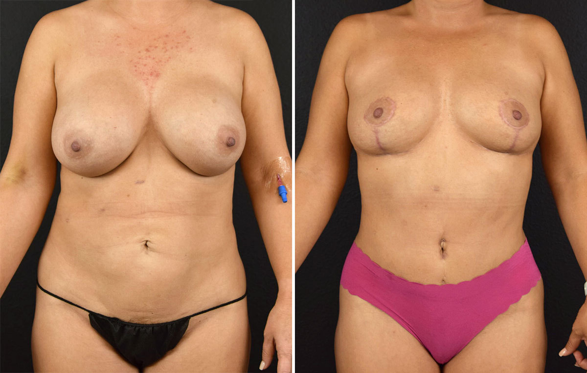 Mommy makeover with breast reduction before and after results