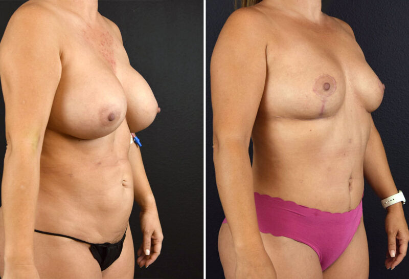 Mommy makeover with breast reduction before and after results