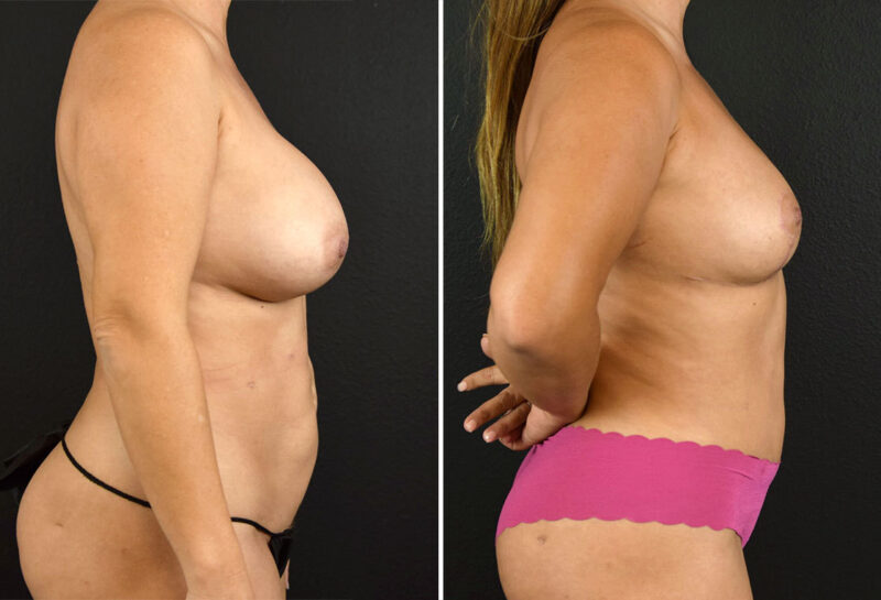 Mommy makeover with breast reduction before and after results