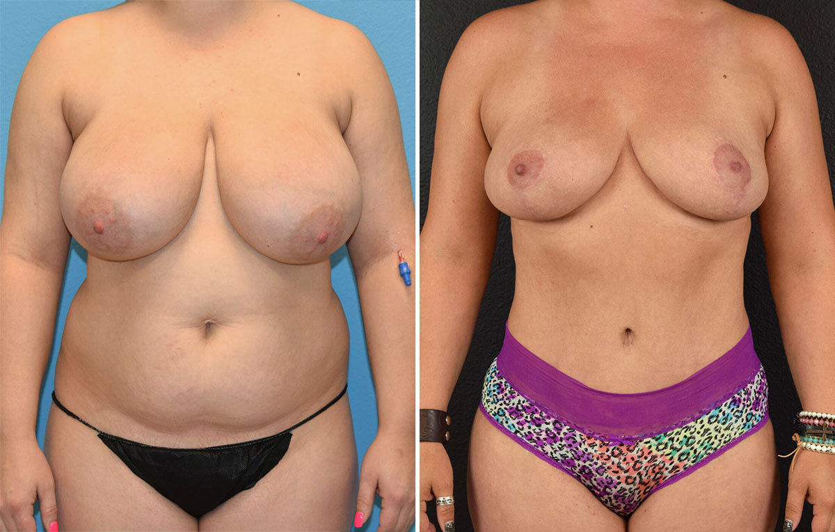 Mommy makeover with breast reduction before and after results