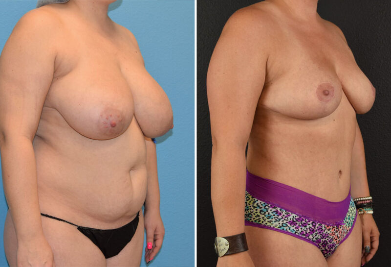 Mommy makeover with breast reduction before and after results