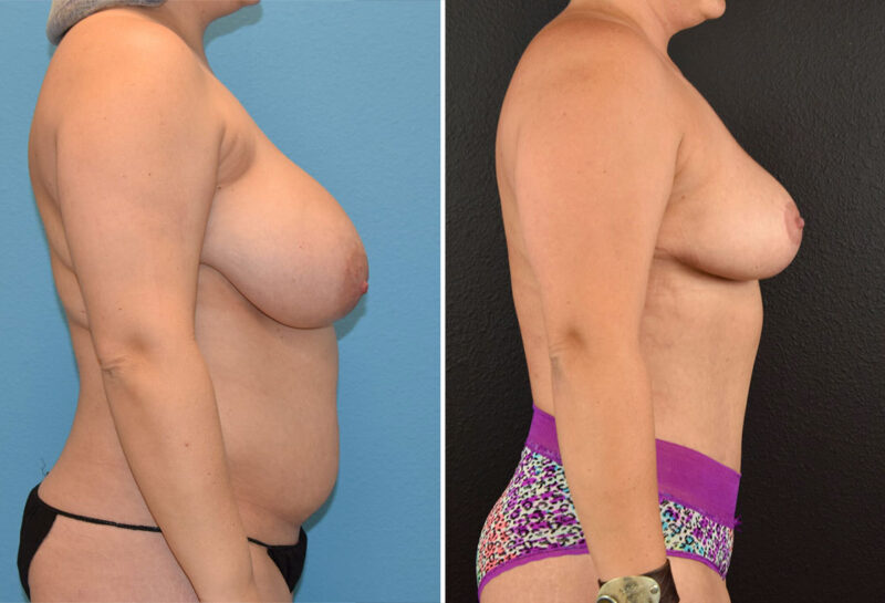 Mommy makeover with breast reduction before and after results